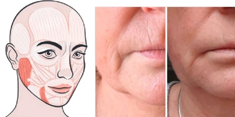 smooth-your-smile-lines