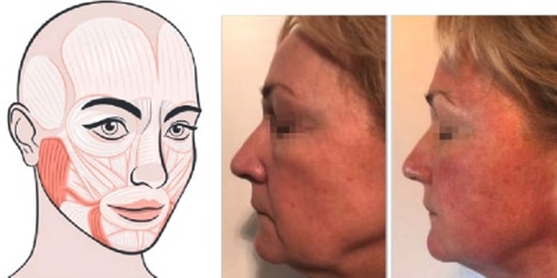 tighten-your-undereye-areas